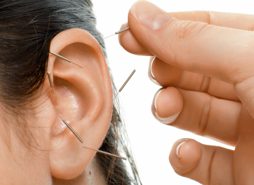 The History and Benefits of Acupuncture as per Mirvana Acupuncture and Chinese Herbs.